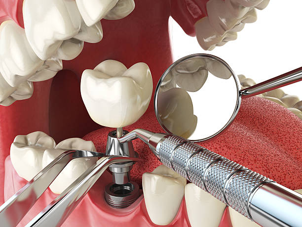 Best Emergency Tooth Extraction in Crump, TN