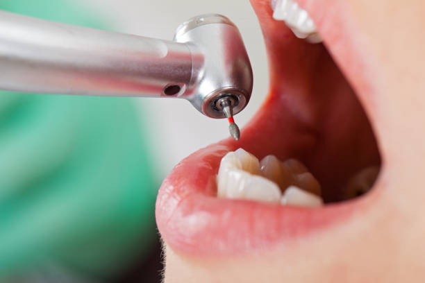 Best Emergency Root Canal Treatment in Crump, TN